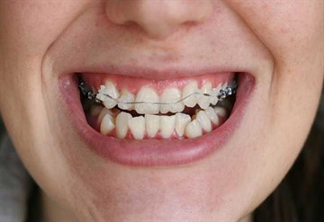 Cât timp ar trebui să poarte aparat dentar pentru a alinia dinții într-un adult, adolescent și copil