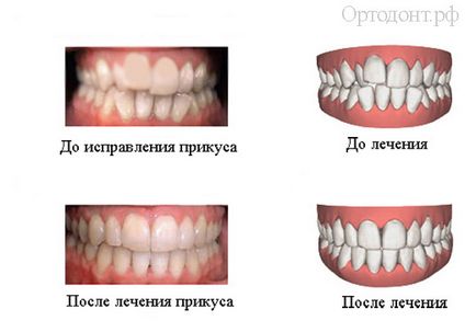 Cât timp ar trebui să poarte bretele răspunsuri la toate întrebările legate