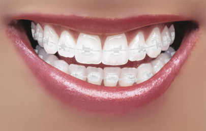 Cât timp ar trebui să poarte aparat dentar analiză detaliată
