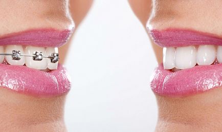 Cât timp ar trebui să poarte aparat dentar - de corecție a temporizării
