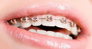 Cât timp uzura acolade pe dinți cu privire la corectarea malocluziei și acolade