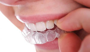 Cât timp uzura bretele pe dinti de copii și adulți