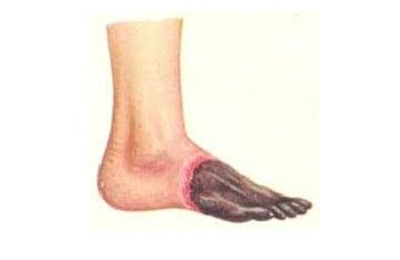 vasele de sânge picior (la nivelul membrelor inferioare), care sunt boli, simptome și tratament
