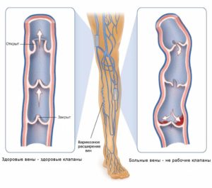 boli vasculare picioare, de ce rănit, care sunt simptomele, fotografie, tratamentul de tratament vascular