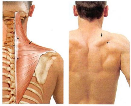 dureri musculare trapez provoacă simptome spasme musculare, ce să facă și cum pentru a calma durerea