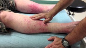 Vasculita pe picioarele lor - un tratament care este aceasta boala si cum sa trateze cauzele, tratamentul de remedii populare