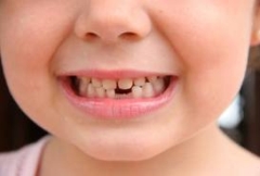 Pierderea dintilor primare la copii, atunci când, cum și de ce