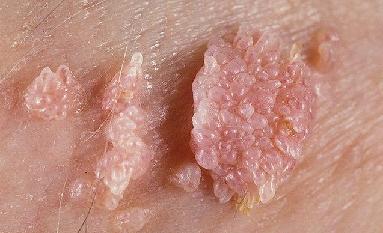 Human Papilloma Virus imagine, simptome și tratament