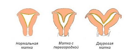 Diagnosticul de sept intrauterine, în timpul sarcinii, în operația de disecție