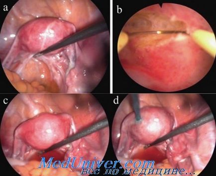 Tratamentul chirurgical al septuri intrauterină