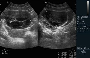Ovarul nu este vizualizat ceea ce înseamnă că, cauzele de vizualizare slabă a dreptului sau de ovar stâng