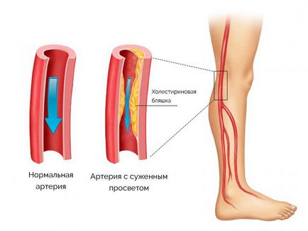 Boala vasculară a extremităților inferioare cauzele și simptomele