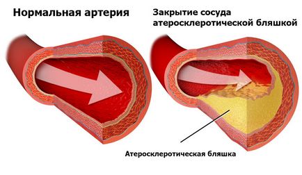 Boala vasculară a extremităților inferioare cauzele și simptomele