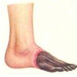 Boala vasculară dintre simptomele picioarelor si tratament