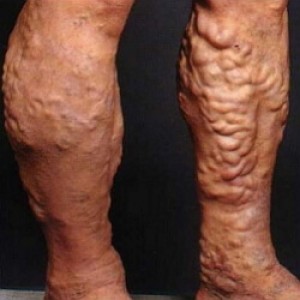 Boli ale inferioare simptomele extremităților și tratamentul bolilor vasculare ale picioarelor