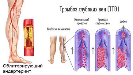 Simptome si semne ale venelor picioarelor, posibile boli, prevenirea