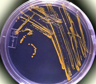 Simptome Staphylococcus aureus și tratament, raportate de infecție stafilococică