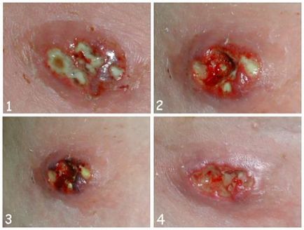 Staphylococcus aureus în simptome de copii, masura, efectele de S. aureus