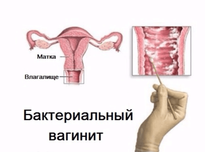Pruritul și arderea în pruriginoasa vaginului ce vagin, provoacă roșeață, iritație decât vindecarea