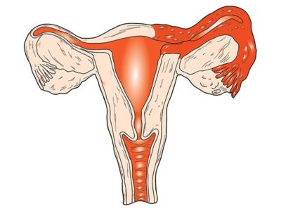 Pruritul și arderea în pruriginoasa vaginului ce vagin, provoacă roșeață, iritație decât vindecarea