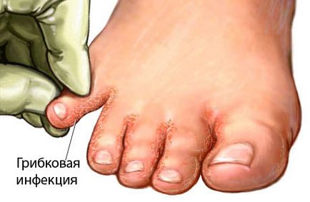 Pruritul între degetele de la picioare decât vindecarea - o prezentare completă a produselor și rețetele oamenilor!