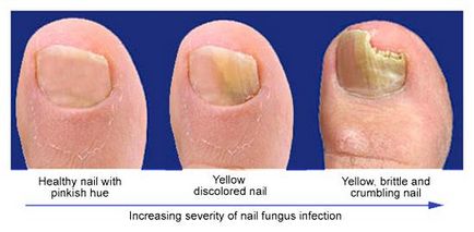 Pruritul între degetele de la picioare decât vindecarea - o prezentare completă a produselor și rețetele oamenilor!