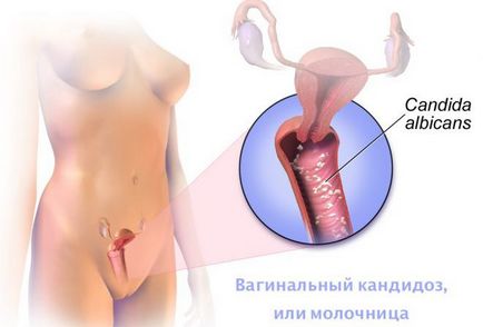 Pruritul in menopauza vagin remedii de tratament populare