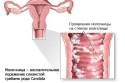 Pruritul în cauzele vagin si modul de a trata