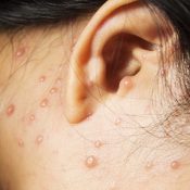 Herpes zoster tratament zona zoster