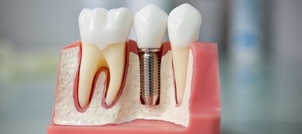 Etape Procedura de implantare dentară