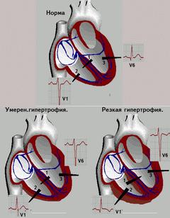 hipertrofiei ventriculului drept
