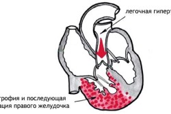 hipertrofiei ventriculului drept ce este