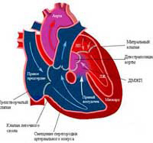 Dreapta simptomele hipertrofiei ventriculare, cauze si tratament - enciclopedie medical