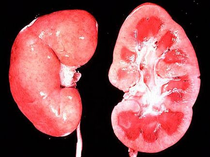 glomerulonefrita-l