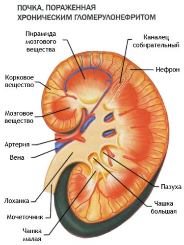 glomerulonefrita-l glomerulonefrita-l