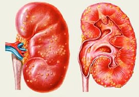 glomerulonefrita-l