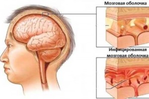 Ce este meningita purulentă