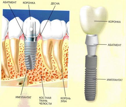 Set implanturi