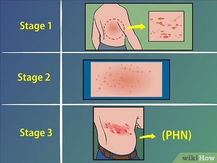 Herpes zoster tratament zona zoster