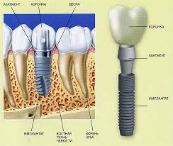 Set implanturi