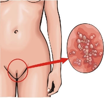 veruci genitale decât vindecarea