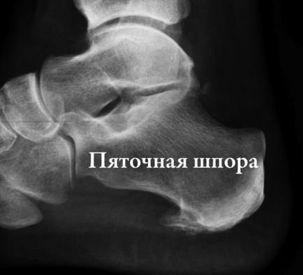 Tratamentul de toc pinteni Dimexidum Tratamentul de toc pinteni Dimexidum