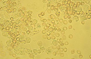 Cum de a crește celulele albe din sânge în urină
