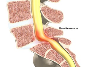 Instabilitatea tratamentului vertebrelor cervicale