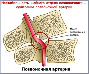 Instabilitatea tratamentului vertebrelor cervicale