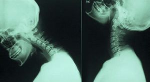 Instabilitatea tratamentului vertebrelor cervicale