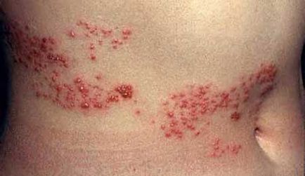 Herpes zoster tratament zona zoster