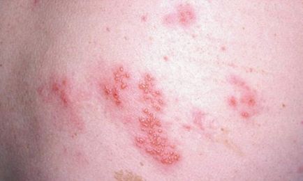 Herpes zoster tratament zona zoster