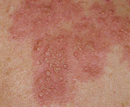 Herpes zoster tratament zona zoster