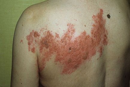 Herpes zoster tratament zona zoster